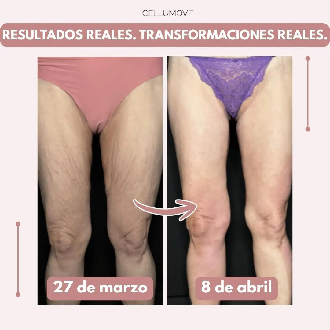 Piernas más firmes y suaves en 14 días — para mujeres cansadas de que la piel flácida las detenga